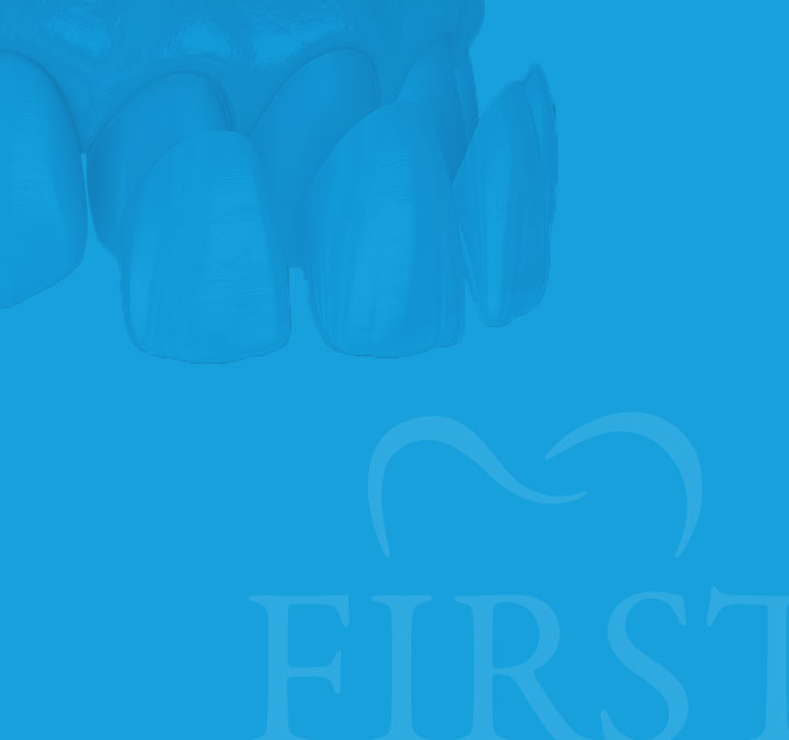 원데이 라미네이트