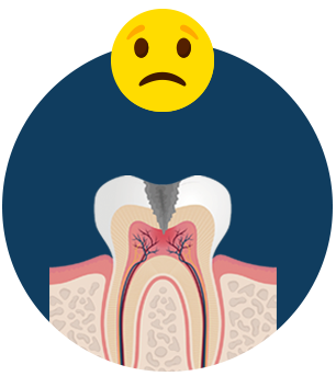 신경치료 후 크라운