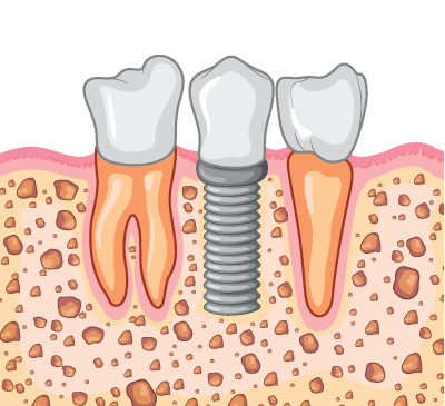 보험 임플란트 치료과정 03