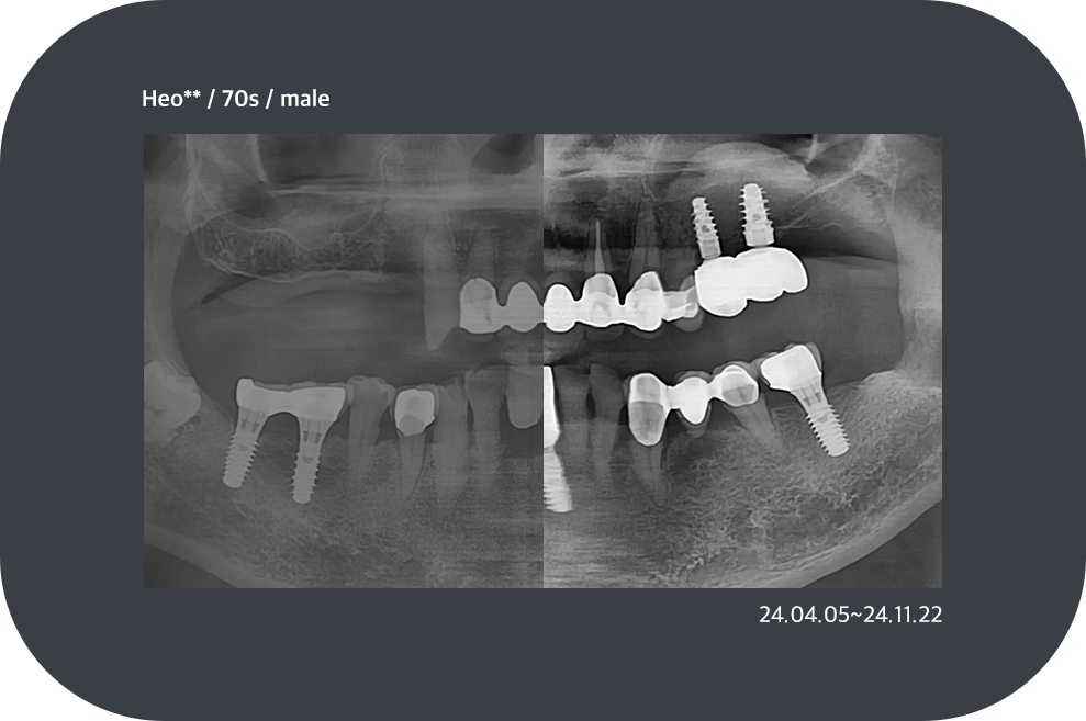 implant_case02