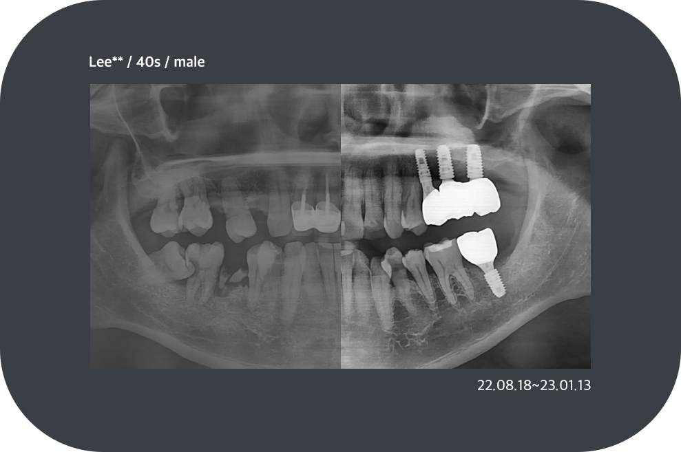 implant_case06