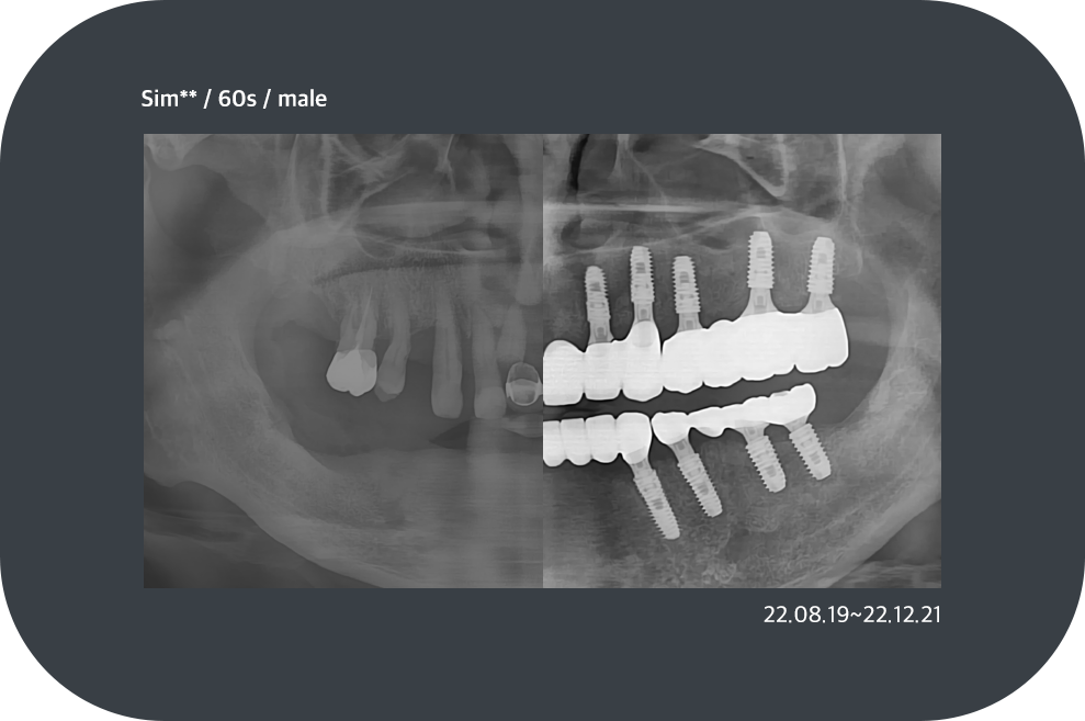 implant_case10