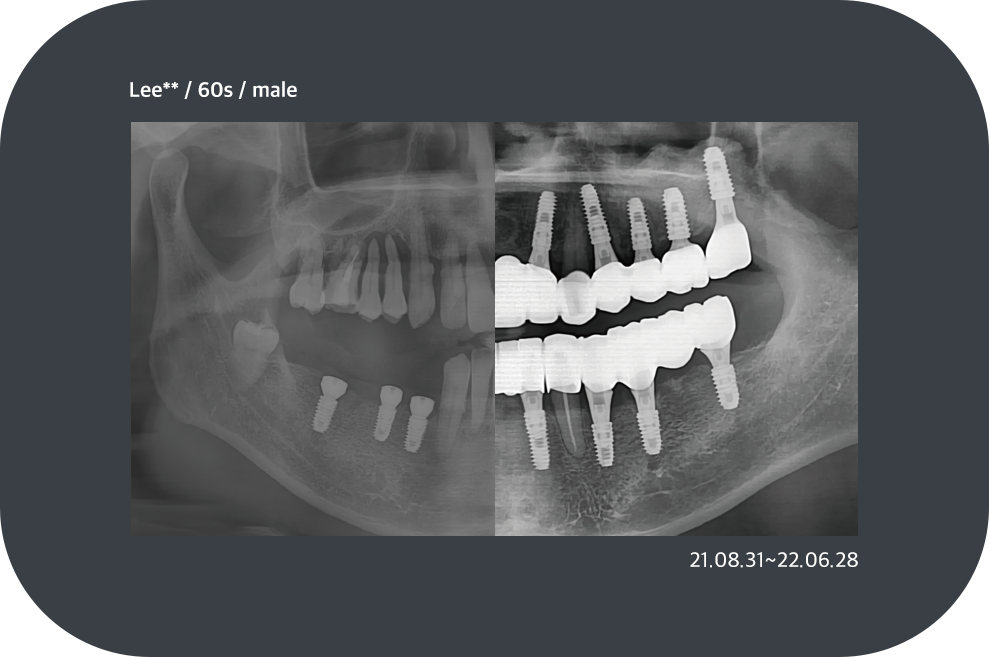 implant_case13