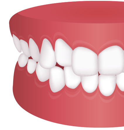 덧니교정 치아모형