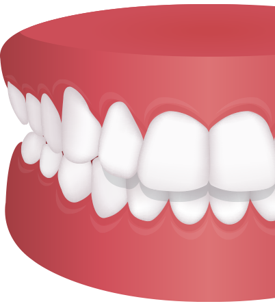 돌출입교정 치아모형