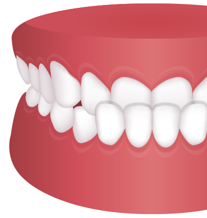 반대교합 치아모형