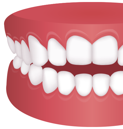 개방교합 치아모형